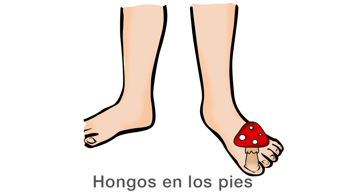 Hongos en los pies