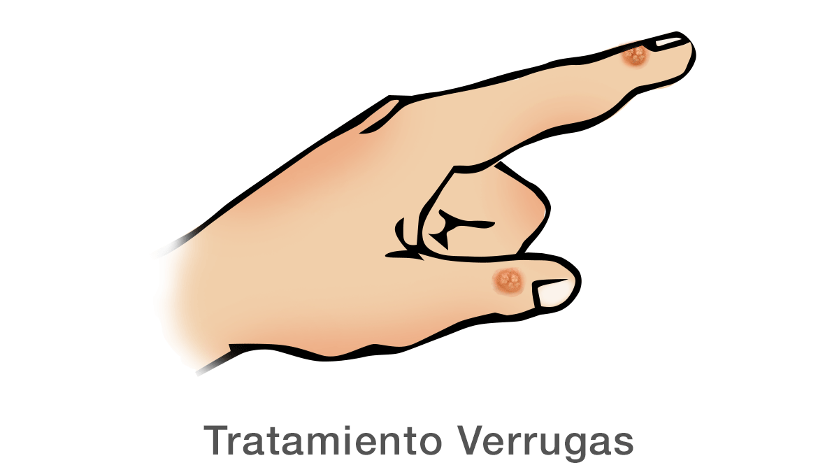Tratamiento de verrugas