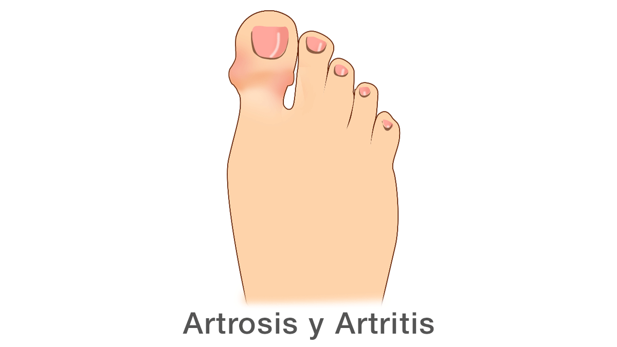 Artrosis y Artritis