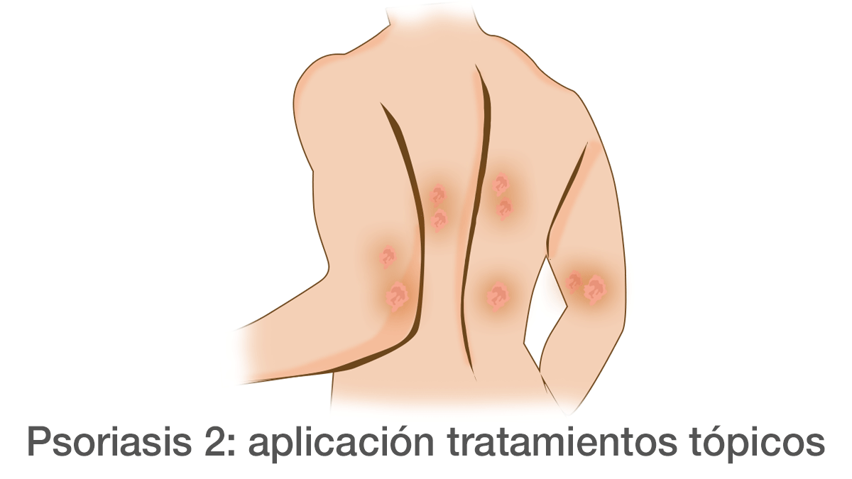 Psoriasis 2ª parte