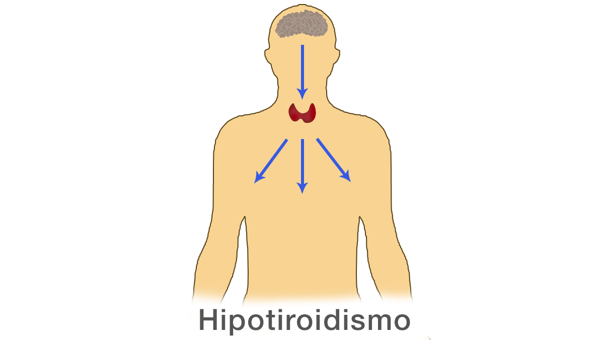 Hipotiroidismo