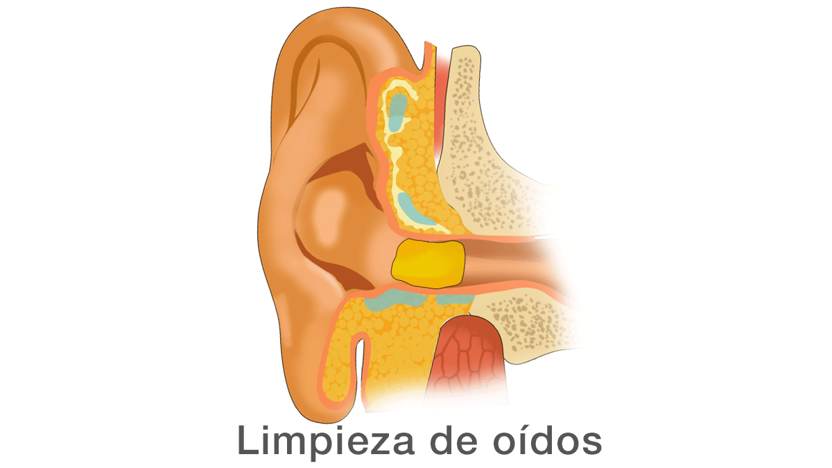 Limpieza de oídos
