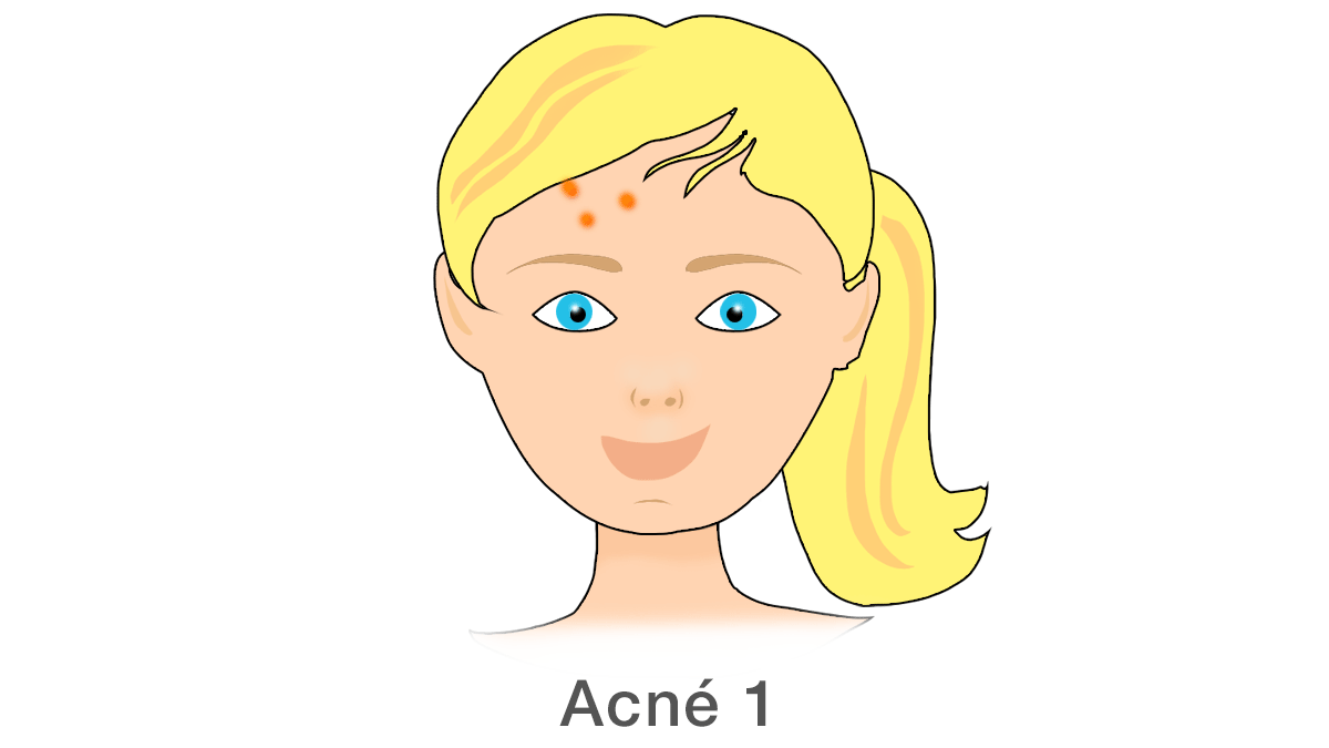 Acné 1
