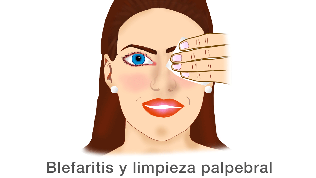 Blefaritis y limpieza palpebral