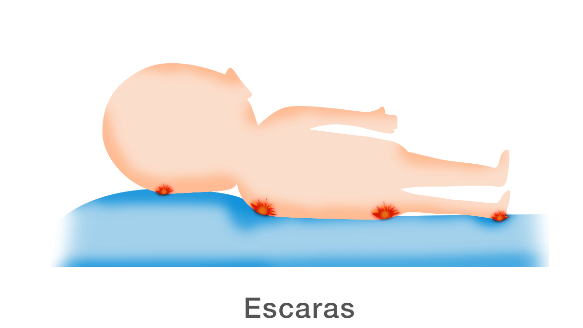 Escaras