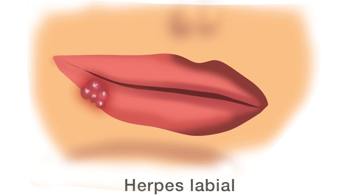 Herpes labial