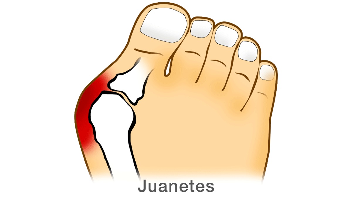 Juanetes