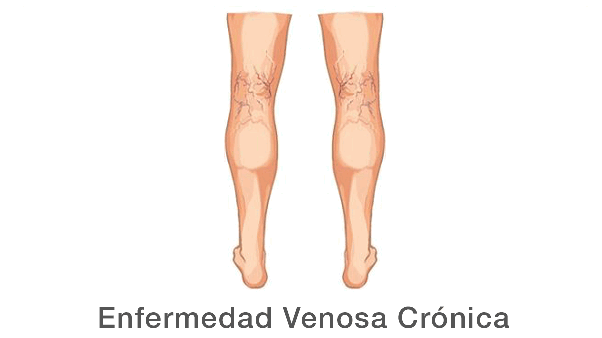 Enfermedad Venosa Crónica