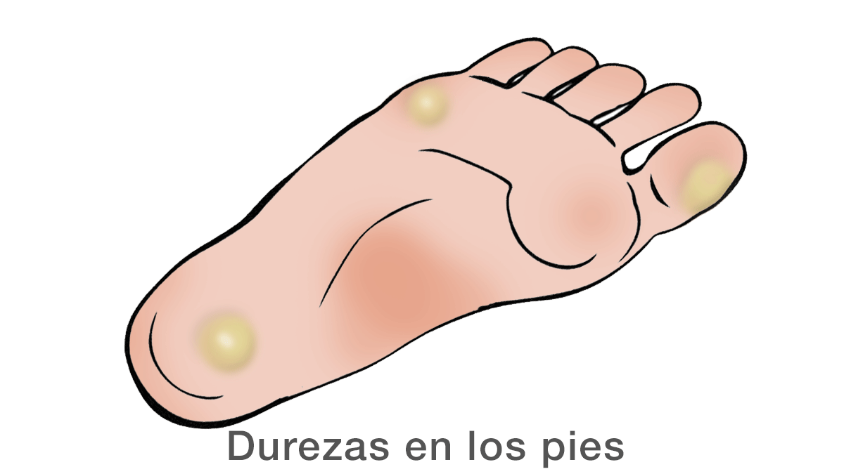 Durezas en los pies